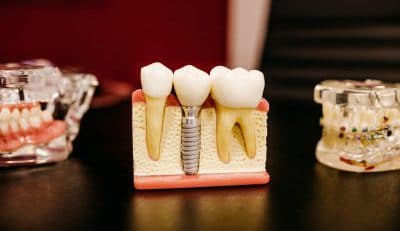 Kroon plaatsen tandarts
